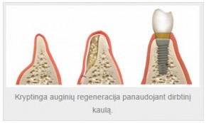 Dantų implantavimas Vilniuje